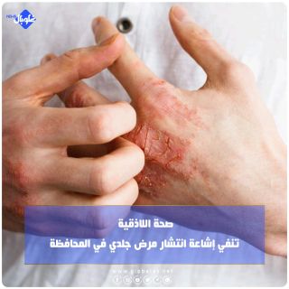 صحة اللاذقية تنفي إشاعة انتشار مرض جلدي بالمحافظة